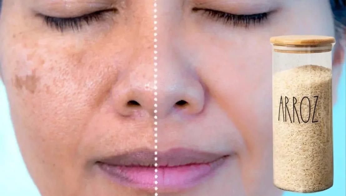 Receita caseira para remover manchas e melasma