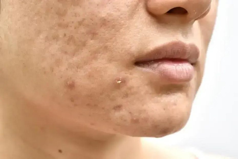 Acne