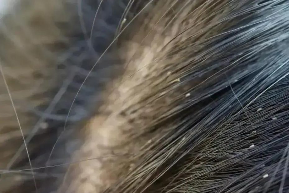 Piolhos e Lêndeas