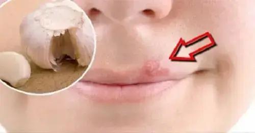 Herpes labial